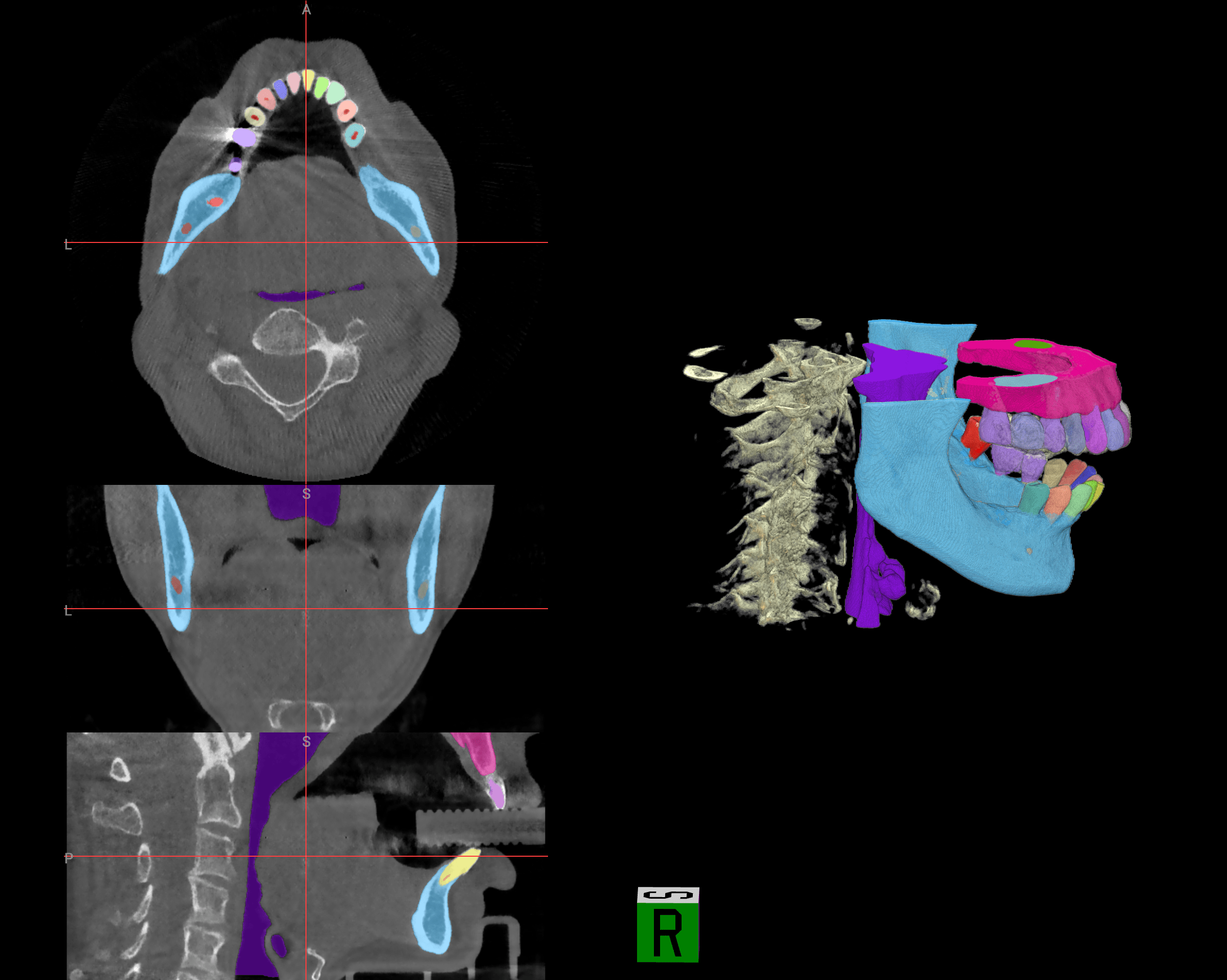 CBCT Image After AI Segmentation