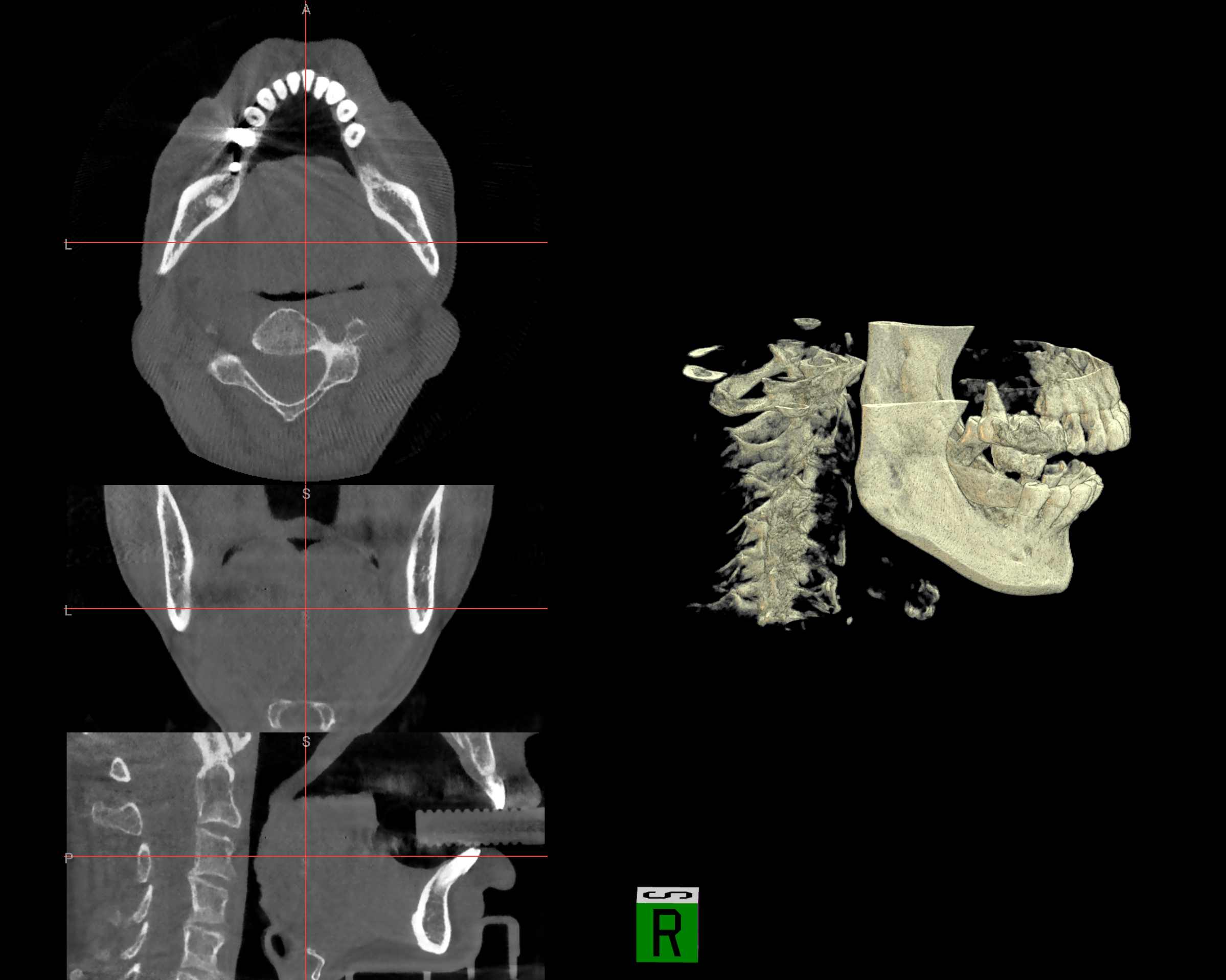 CBCT Image Before AI Processing